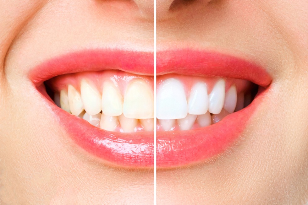 a-closer-look-at-teeth-whitening-trends